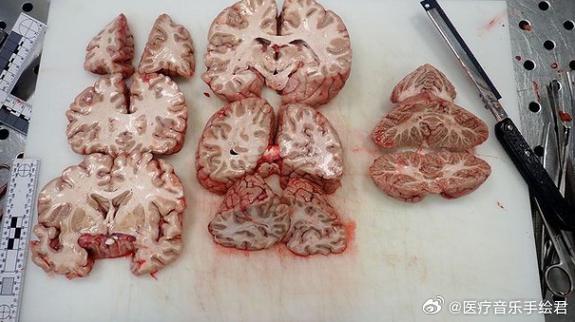 脑梗脑切片的病理描述