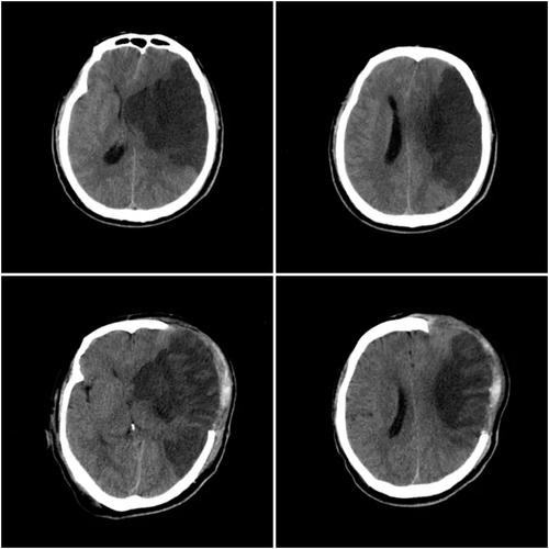 脑CT显示有脑梗病灶