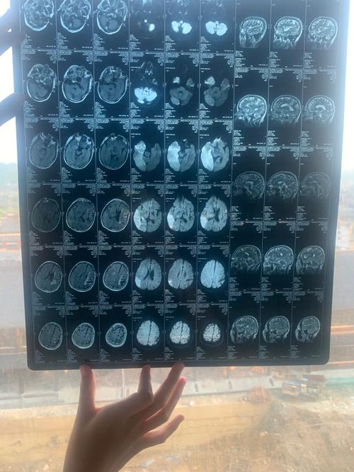 脑CT显示有脑梗病灶