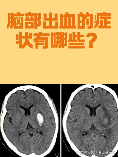 脑梗脑耳朵放血出血块