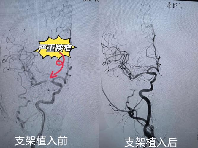 胼胝体脑梗做了脑支架