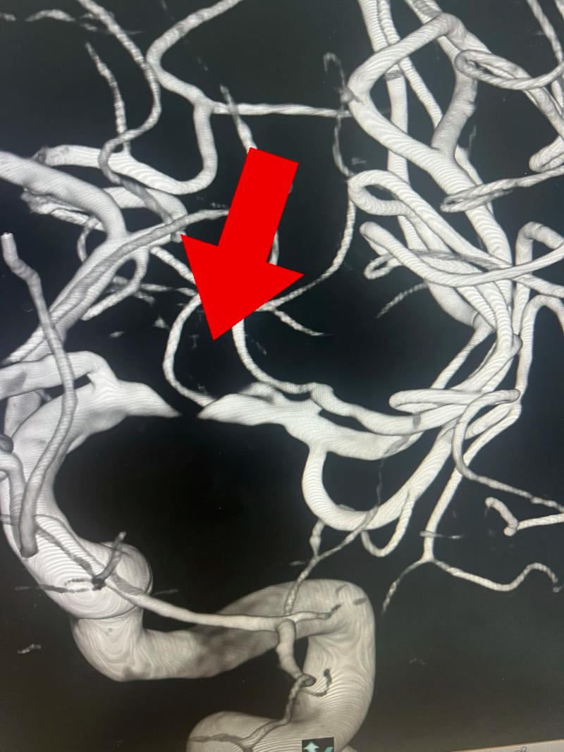 胼胝体脑梗做了脑支架