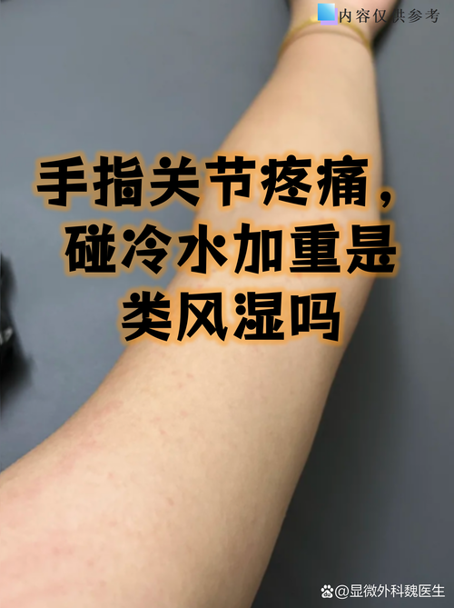 疼会一直伴随类风湿吗