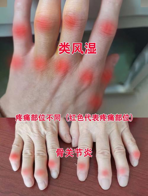 风湿性关节炎引起发烧