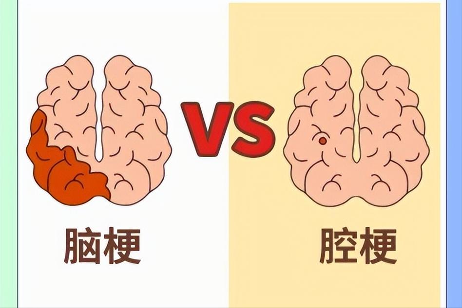 怎样区别脑梗还是脑沟