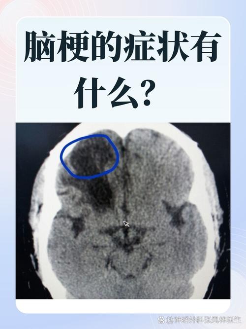 脑钙化和脑梗那个严重