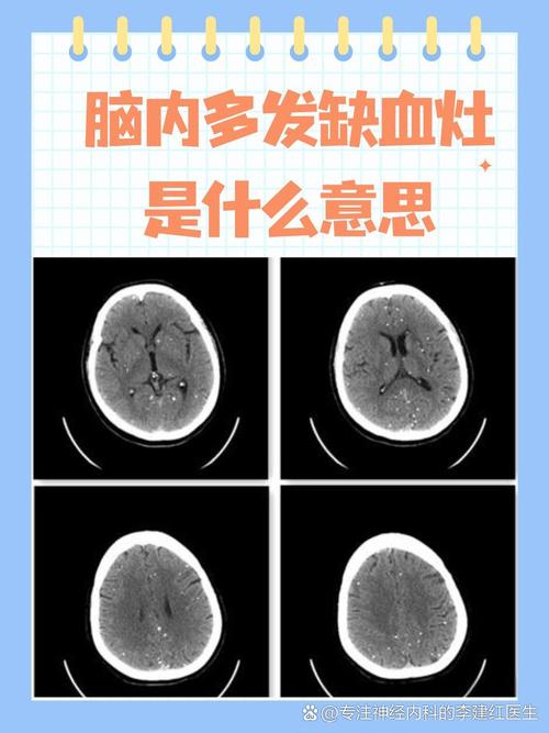 脑内多发缺血灶 脑梗