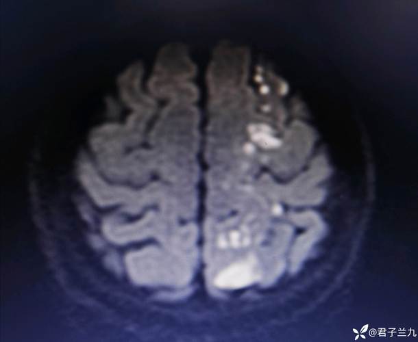 脑梗 flair显影