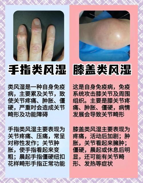 类风湿病是怎么引起的