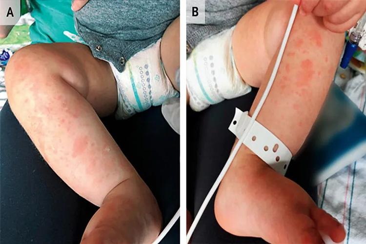 儿童急性风湿性关节炎