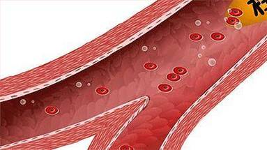 急性脑梗心梗阿司匹林