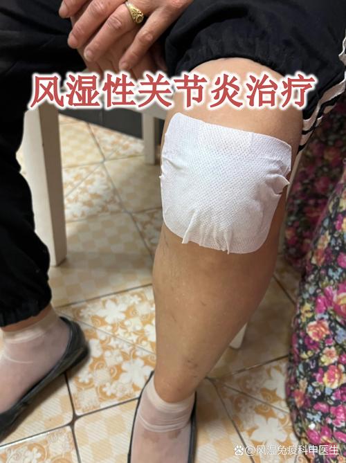 治疗急性风湿性关节炎