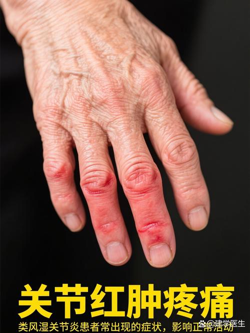 激素药对类风湿关节炎