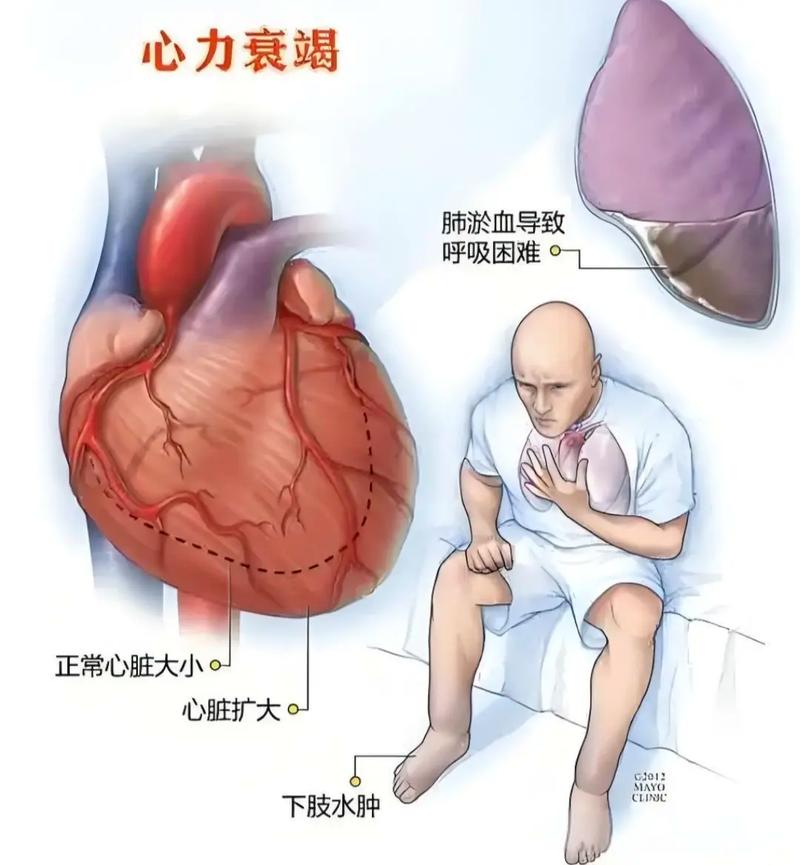 得了心梗 脑梗 心衰