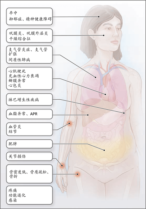 风湿性关节炎发病机制