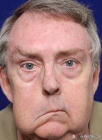 风湿性心脏病症状面容