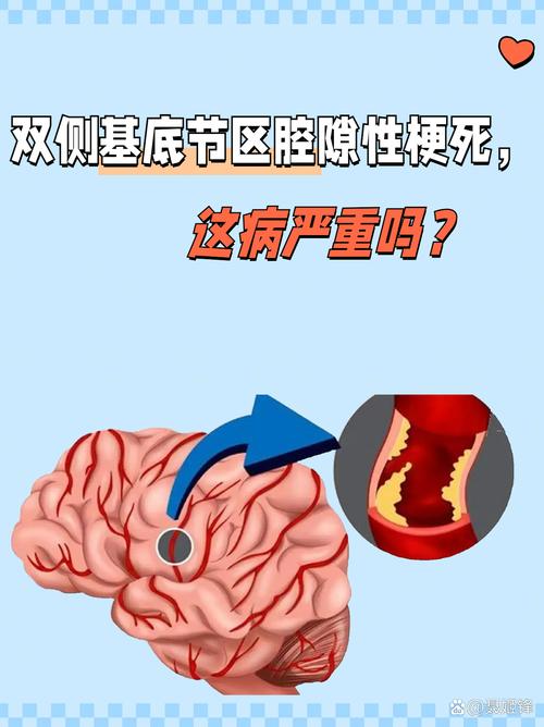 脑梗与腔隙性脑梗区别
