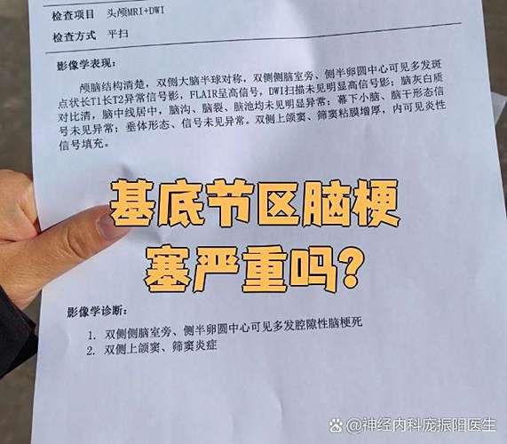 基底节脑梗为什么脑梗