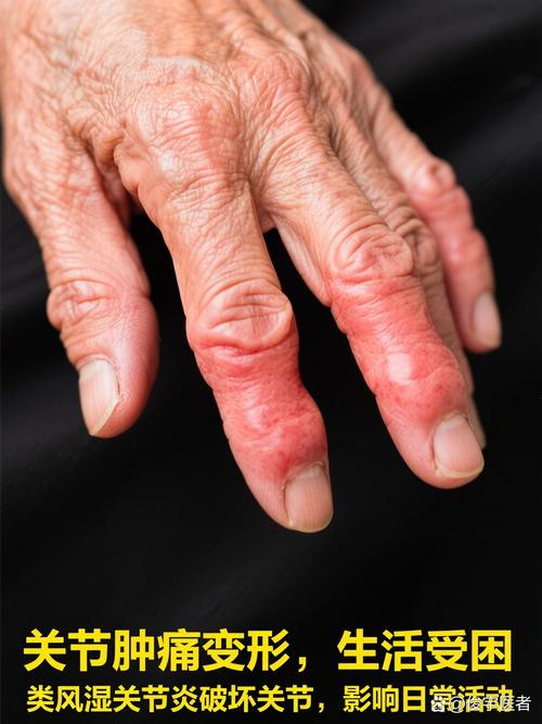 手指关节炎是类风湿吗