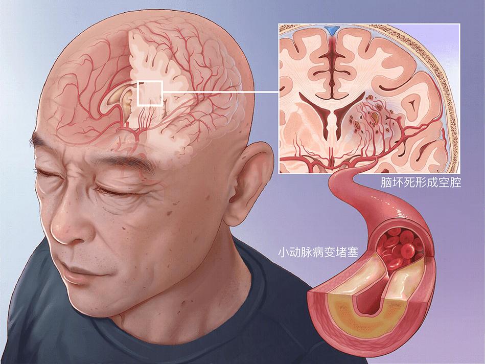 腔系脑脑腔梗成丘脑梗