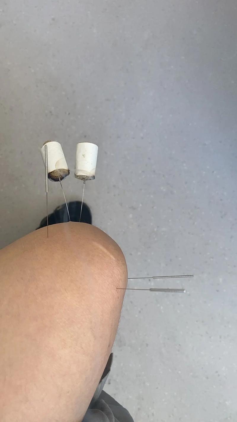 膝盖风湿性关节炎针灸