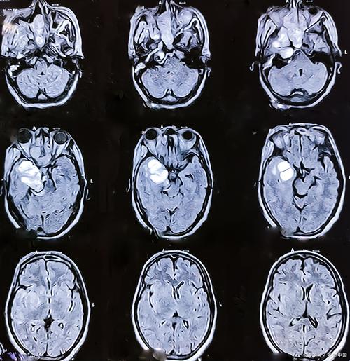 脑软化 脑梗 MRI