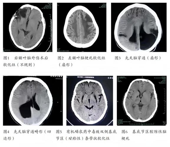 脑软化 脑梗 MRI