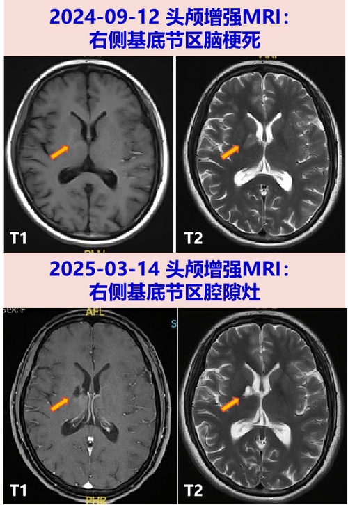 脑软化 脑梗 MRI