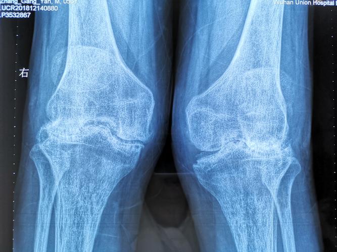 风湿性关节炎影像表现