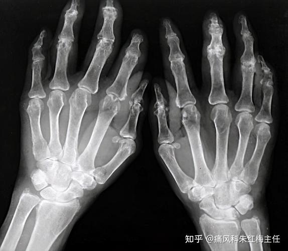 风湿性关节炎影像表现