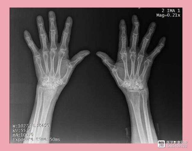 类风湿关节炎体格检查