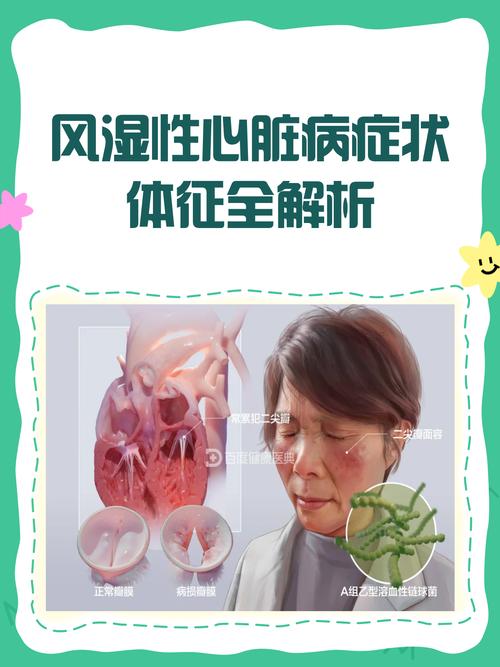 风湿性心脏病能治疗吗