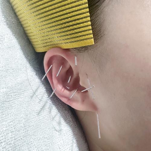 脸部面瘫打针灸穴位