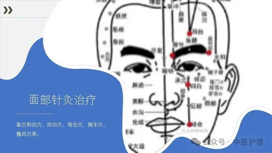 脸部面瘫打针灸穴位