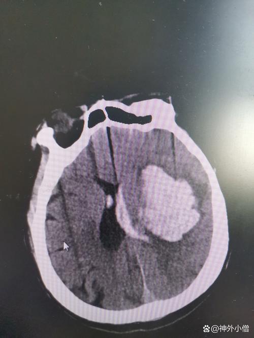 脑出血十年后出现脑梗