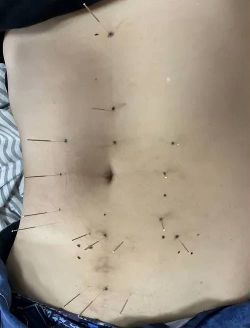 腹针常用穴位有哪些