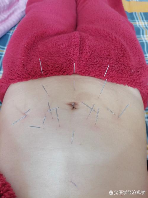 腹针常用穴位有哪些