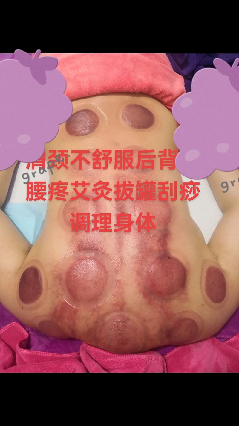 艾灸拔罐能治风湿病吗