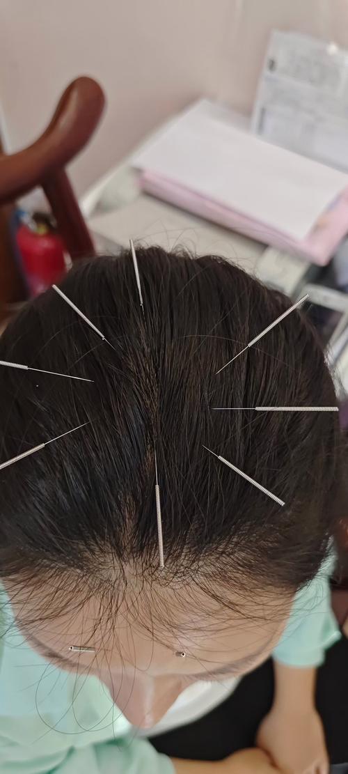 头痛针灸最好的穴位