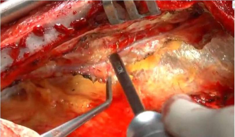 风湿性心脏病手术过程