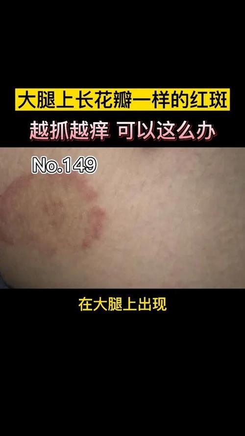 风湿性关节炎环形红斑