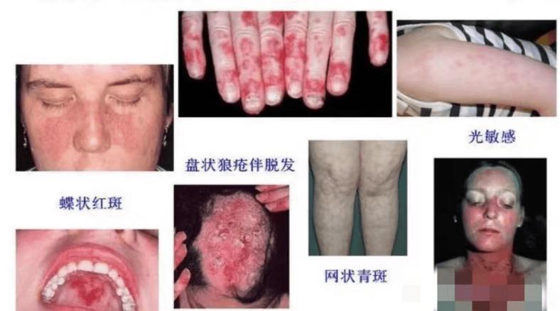 风湿病是几型变态反应