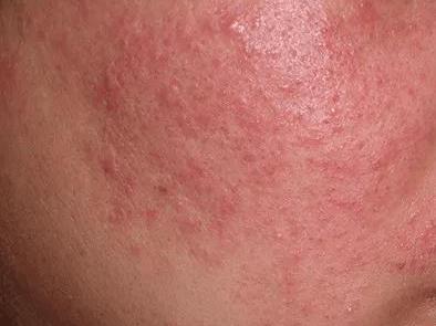 风湿病是几型变态反应