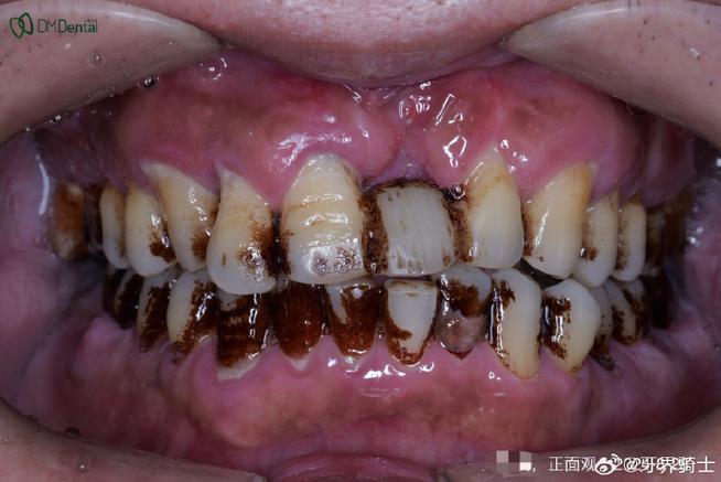 脑梗口齿越来越不清楚