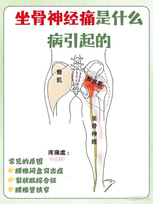 风湿引起的坐骨神经痛