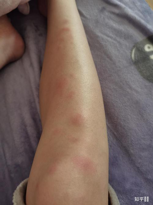 结节性红斑是风湿病吗