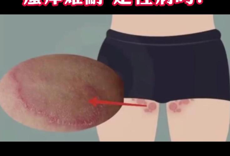 结节性红斑是风湿病吗