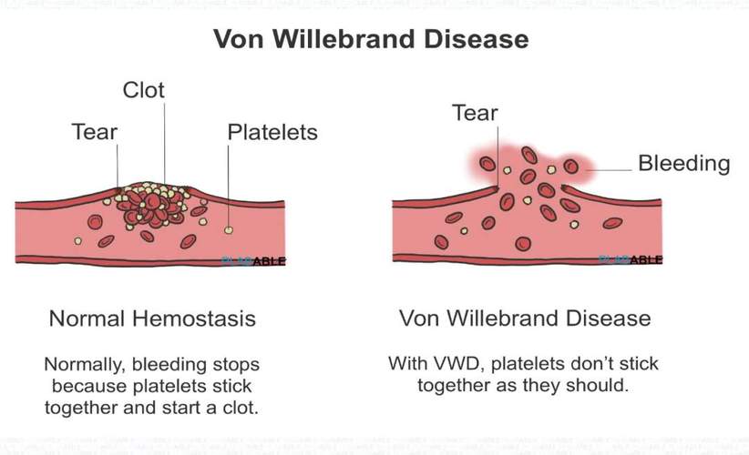 类风湿性血管炎 英文