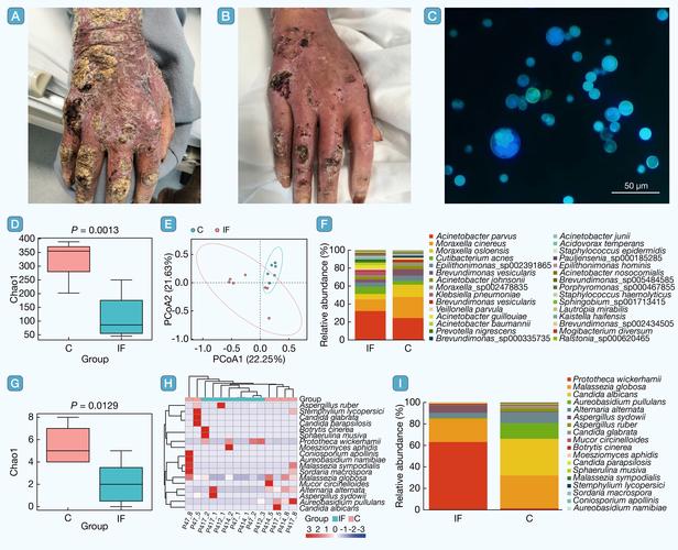 类风湿性血管炎 英文