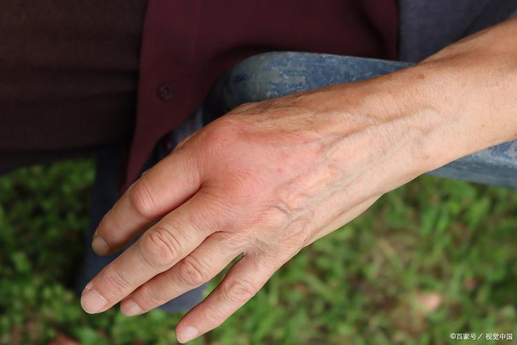 类风湿病人破皮怎么为